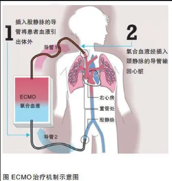 “人工肺”----ECMO 击退死神，胜过万分之一